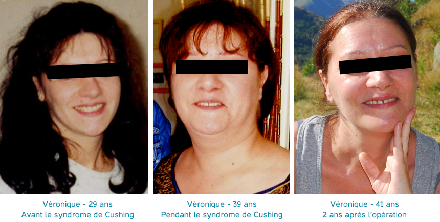 Véronique avant et après le syndrome de Cushing