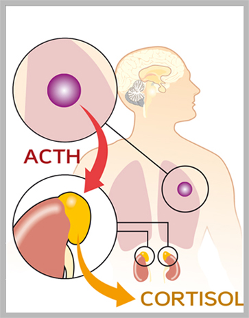 Sécrétion ectopique d'ACTH par une tumeur endocrine